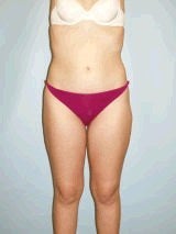 Liposuction Surgery after 143956