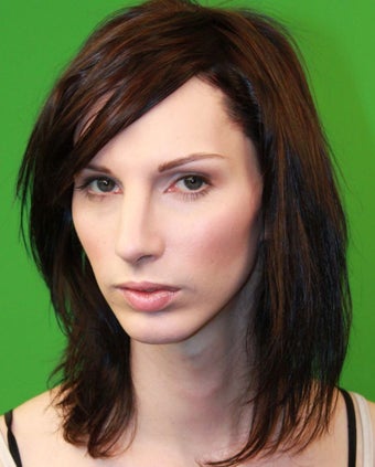 Rhinoplasty after 270386