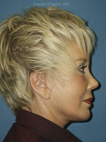 Facelift, Endoscopic Browlift, Upper and Lower Blepharoplasty with canthopexy, Perioral and Glabellar Dermabrasion after 248865