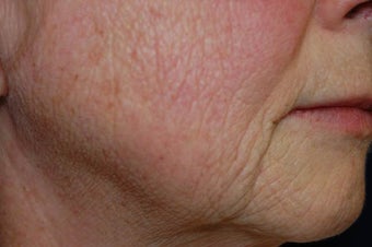 Fractional CO2-Total FX Wrinkle Treatment before 572421