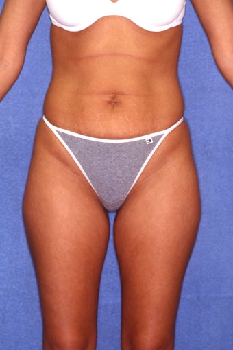Tummy Tuck with Liposuction before 410981