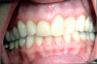 Combination of crowns, veneers, and gum surgery before 240558