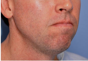 Jawline Augmentation before 524379