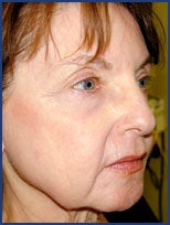 CO2 laser skin resurfacing after 87080