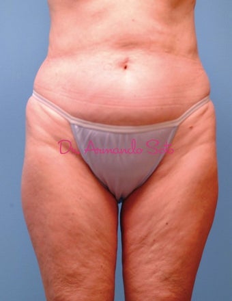 Lipoabdominoplasty before 141563