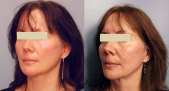 Sculptra treatments after 125340