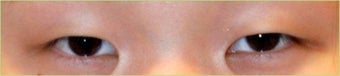 Asian Double Eyelid Surgery - Asian Blepharoplasty before 166204