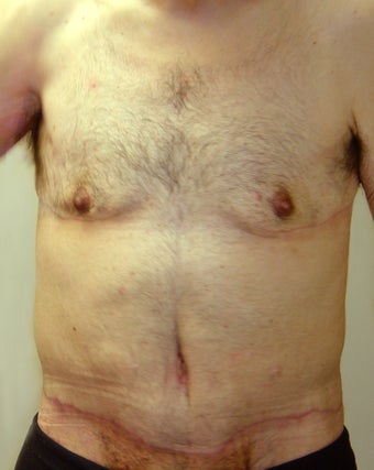 Bodylift & removal of excess chest skin after 527247