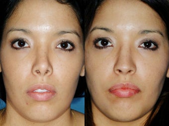 Revision rhinoplasty before 395565