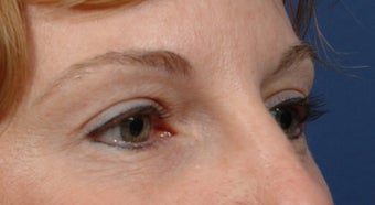 Endoscopic Browlift and Upper lid Blepharoplasty after 414272