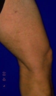 Sclerotherapy after 370423