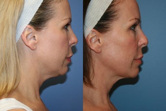 Smart Lipo MPX neck liposuction before 77132