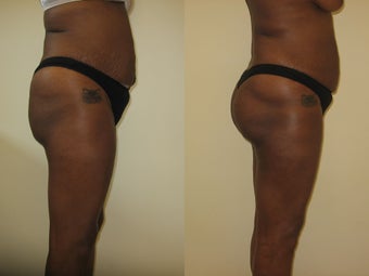 Gluteal augmentation before 220822