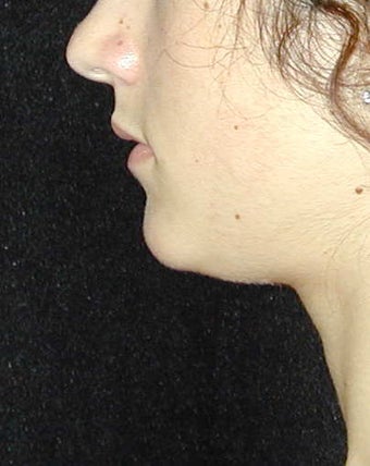 Chin Implant before 101323