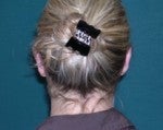 Ear Pinning after 519249