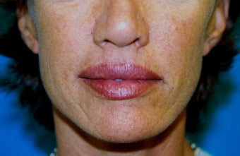 Upper and Lower Direct Lip Lift after 409920