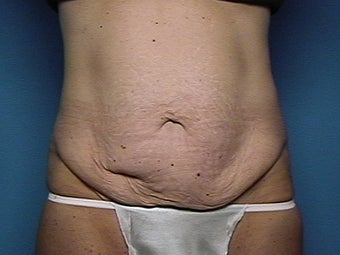 Abdominoplasty before 134581