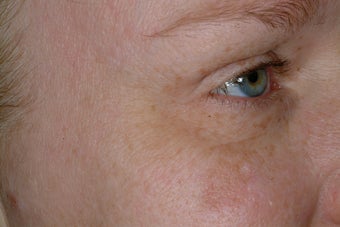 Non-surgical eye rejuvenation after 95918