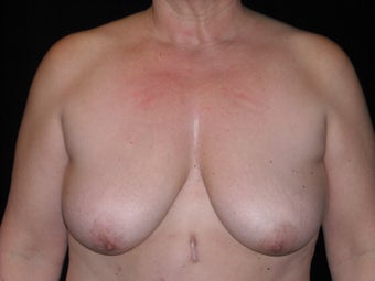 Breast lift (mastopexy) before 231908