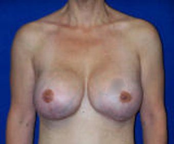 Reconstruction Surgery after 121775