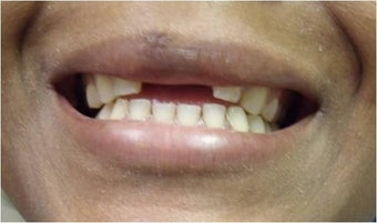 Mini Dental Implants replacing missing front teeth before 402361
