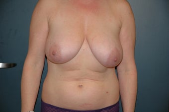 Breast reduction and lift before 152479