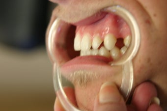 porcelain bridge with veneers replacing teeth before 466255