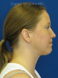Chin implant Exchange for a more contemporary size medium chin implant and Necklift with 15cc of VASER liposuction of the neck. after 250170