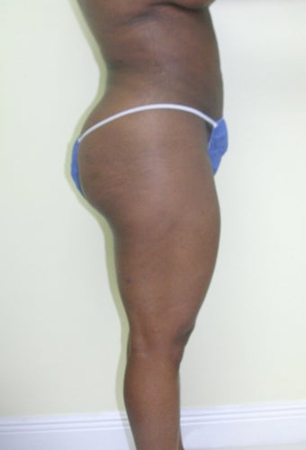 Brazilian butt lift 365596