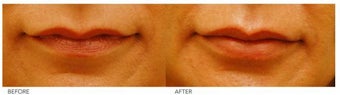 Lip Reduction/Lip Correction before 136723