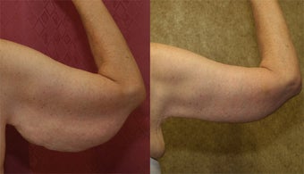 arm lift or brachioplasty before 242122