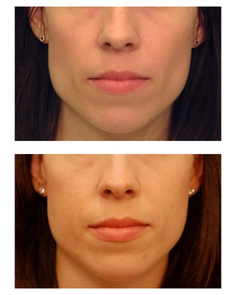 Cheek Augmentation before 347496