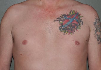 Pec Implants before 521679