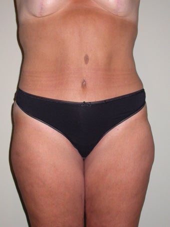 Abdominoplasty after 611782