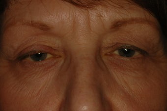 Bilateral Eyelid Lift and Blepharoplasty before 313336