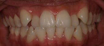 Invisalign before and afters before 151761