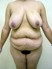 Mommy makeover before 281907