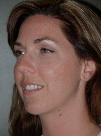 Chin Augmentation Surgery, Non-Surgical Under Eye Dermafillers after 136234