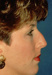 Rhinoplasty before 319080