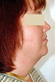 Neck Liposuction before 87335
