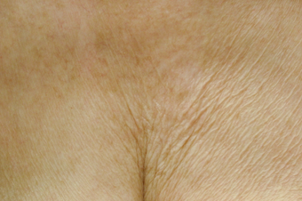 Affirm CO2 to Chest Area before 200600