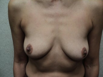 Breast Augmentation before 630241