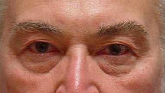 Lower blepharoplasty with fat repositioning before 251709