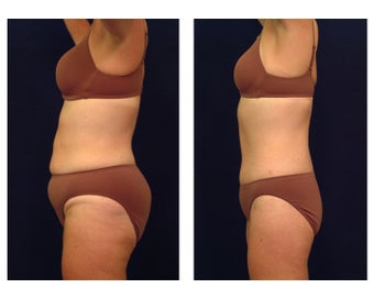 Tummy Tuck or Abdominoplasty before 283089