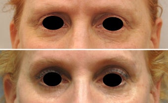 Botox around eyes before 388080