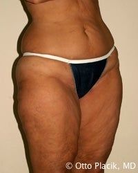 Thigh and Buttock Lift 566621