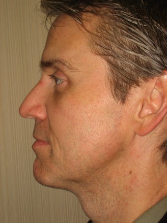 42 year old male before and after SmartLipo of the neck after 626272