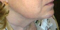 Thermage after 272047