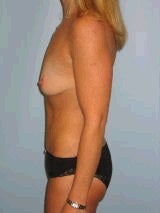 Breast Augmentation 417444
