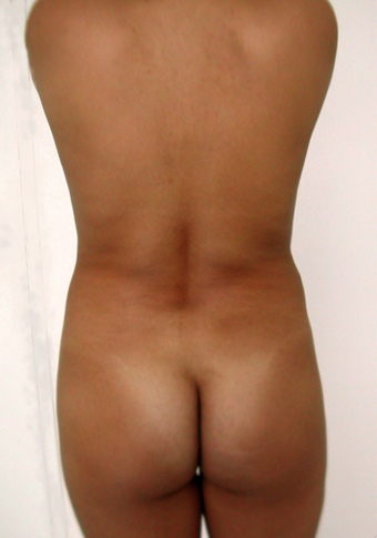 Back Lift before 229656